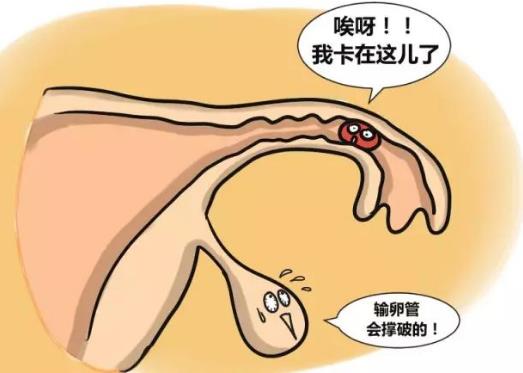 输卵管妊娠的自我检查、症状及治疗方法-六美集