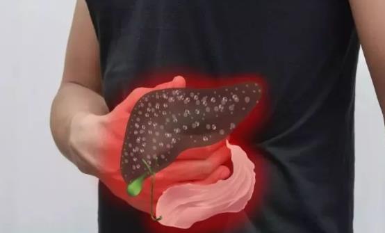 治疗黄疸型肝炎的9则小偏方 能有效治疗黄疸型肝炎-六美集